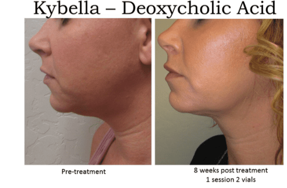 kybella, double chin, Aesthetic Assets