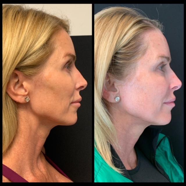 Your Nonsurgical, 3D Facelift Options