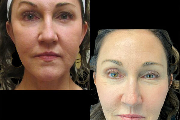 3D Facelift