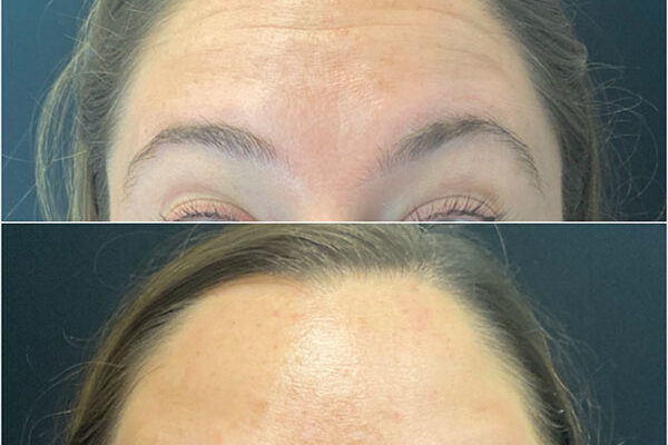 Botox