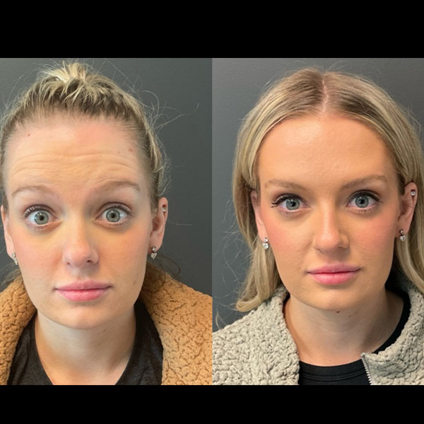 2 weeks post Botox (1)b