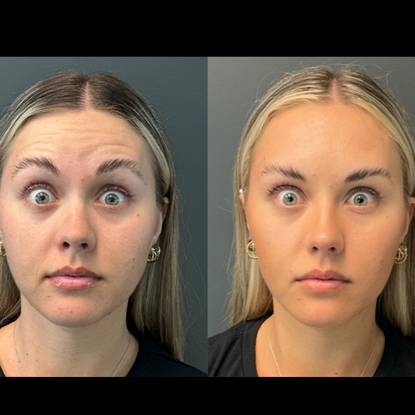 2 weeks post Botox (2)b