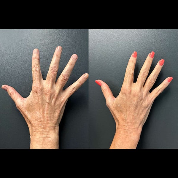 Bellafill-Hand-Rejuvenation-4-2
