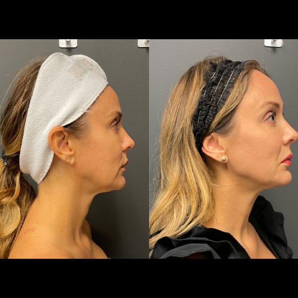 RF-Microneedling-1-1