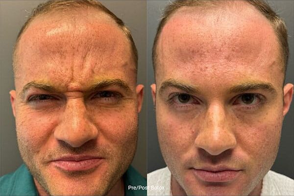 botox-15