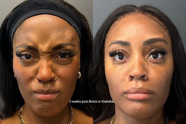 ba-botox-26-2.jpg