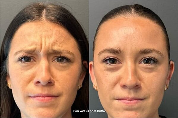 ba-botox-27-1