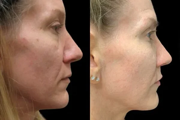 3d-facelift-sculptra