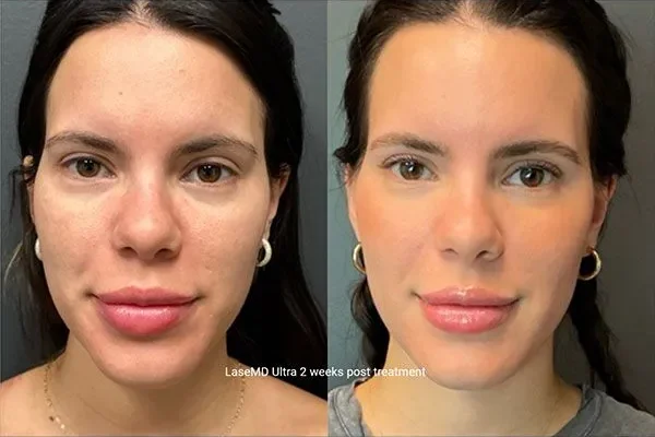 laseMD-ultra-3