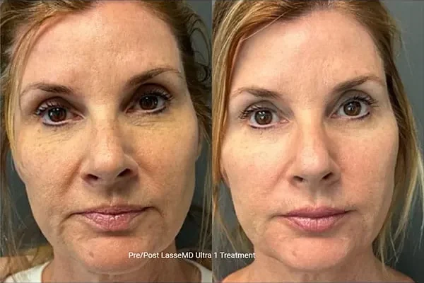 laseMD-ultra-x1-1