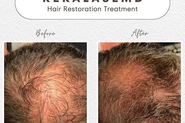 Hair-Rejuvenation-2 Hair-Rejuvenation-2