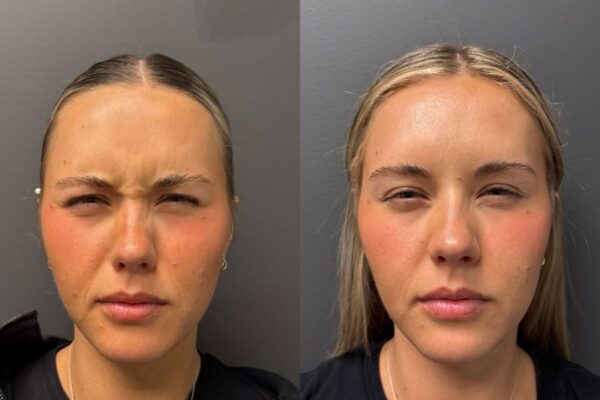 botox-1b