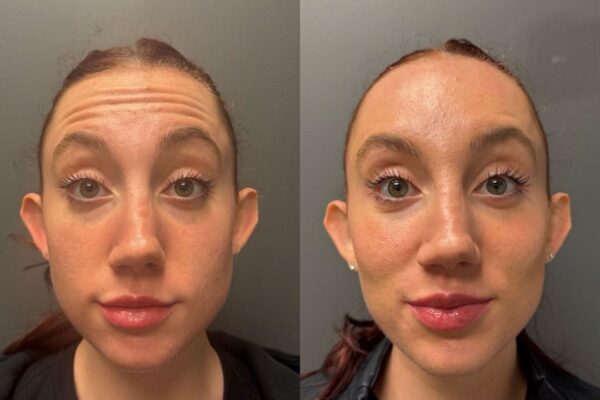 botox-3b