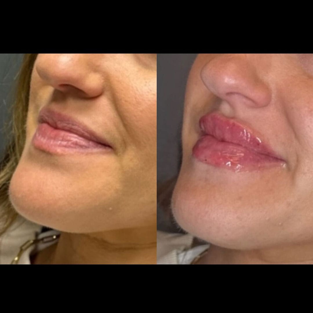 lip-filler-26-b