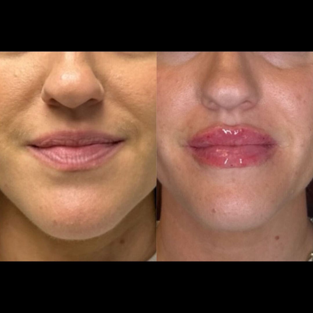 lip-filler-26-c