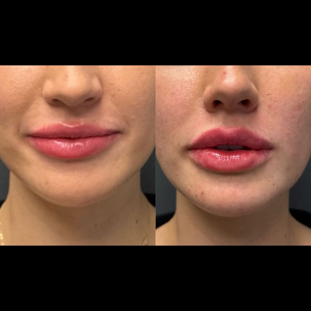 lip-filler-27-a